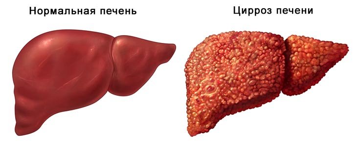 Новости про - Последняя стадия цирроза, признаки у мужчин и женщин, прогноз и как лечить