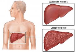 Новости про - Эластометрия печени, что это такое, её нормальные показатели и подготовка к процедуре