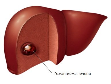 Новости про - Причины появления гемангиомы печени у взрослых и детей, чем она опасна и как ее лечить