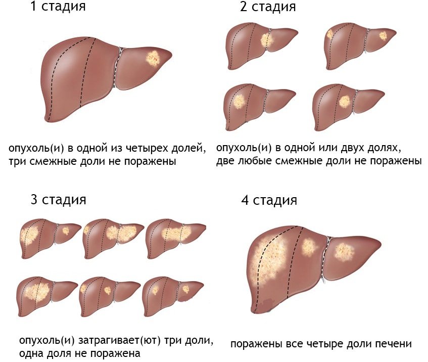 Новости про - Проявления онкологии печени, можно ли вылечить и классификация