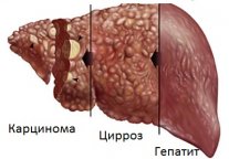 Новости про - Продолжительность жизни мужчин и женщин с циррозом в зависимости от стадии и симптомов