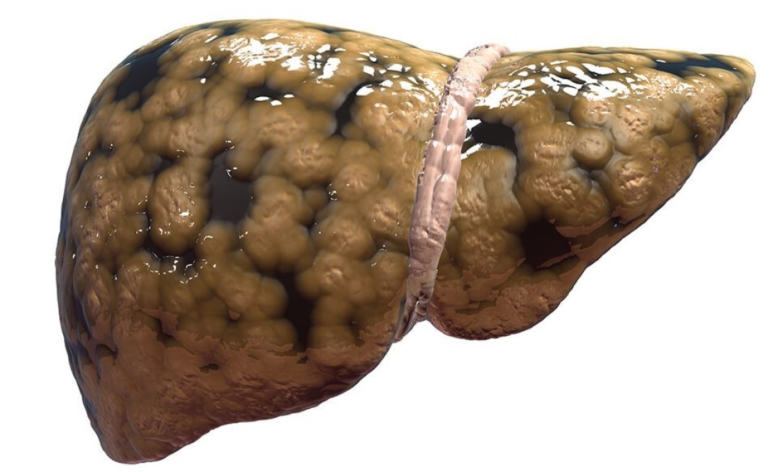 Новости про - Как лечить стеатоз, признаки жировой дистрофии и ожирения печени