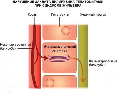 Новости про - Болезнь Жильбера, что это такое простыми словами, как снизить билирубин, какие таблетки пить и противопоказания